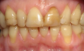 Nachher - Behandlung Zahnarztpraxis Schmieder Mallorca