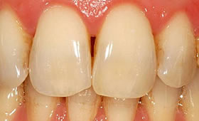 Nachher - Behandlung Zahnarztpraxis Schmieder Mallorca
